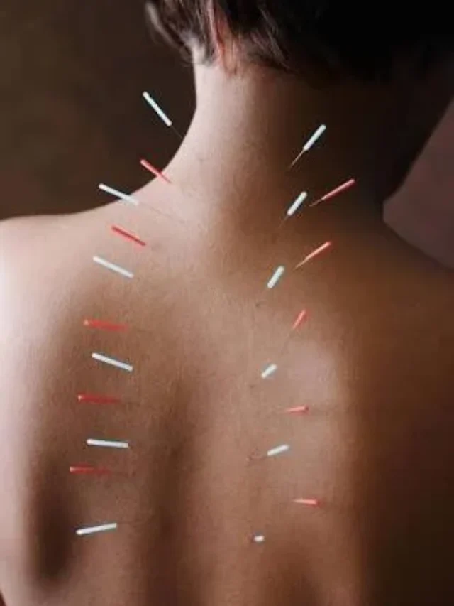 Is Acupuncture Helpful? Discover Its Benefits