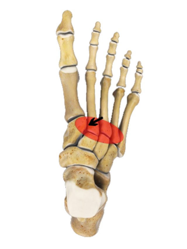 Understanding Lisfranc Injury